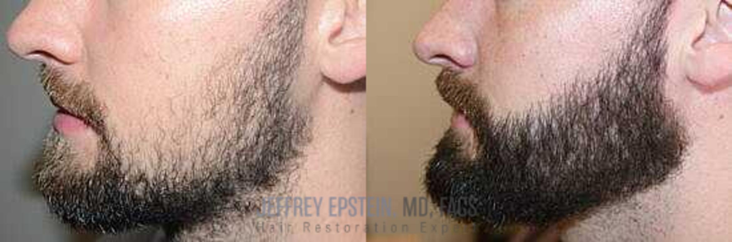 Before & After Beard Transplant Case 383 View 1 View in Miami, FL