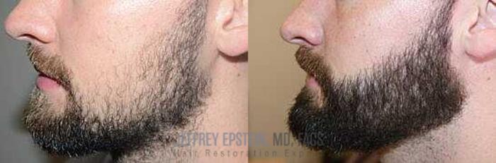 Before & After Beard Transplant Case 383 View 1 View in Miami, FL