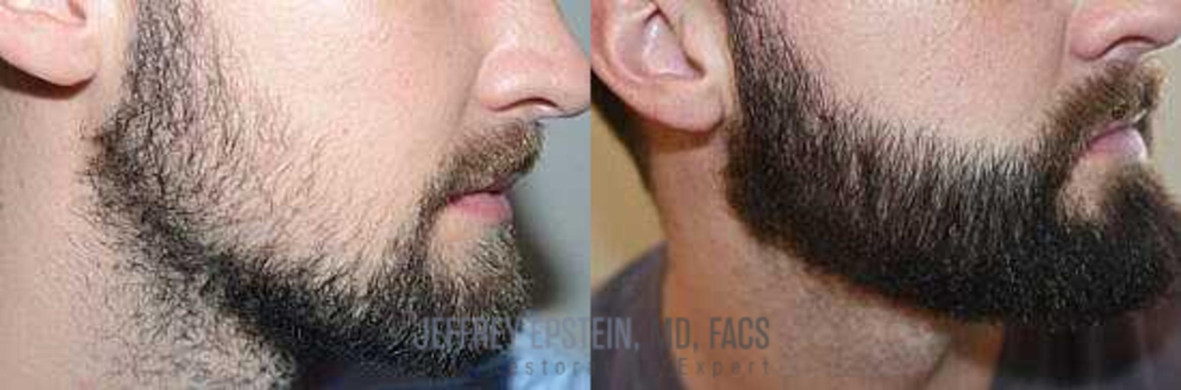 Before & After Beard Transplant Case 383 View 2 View in Miami, FL