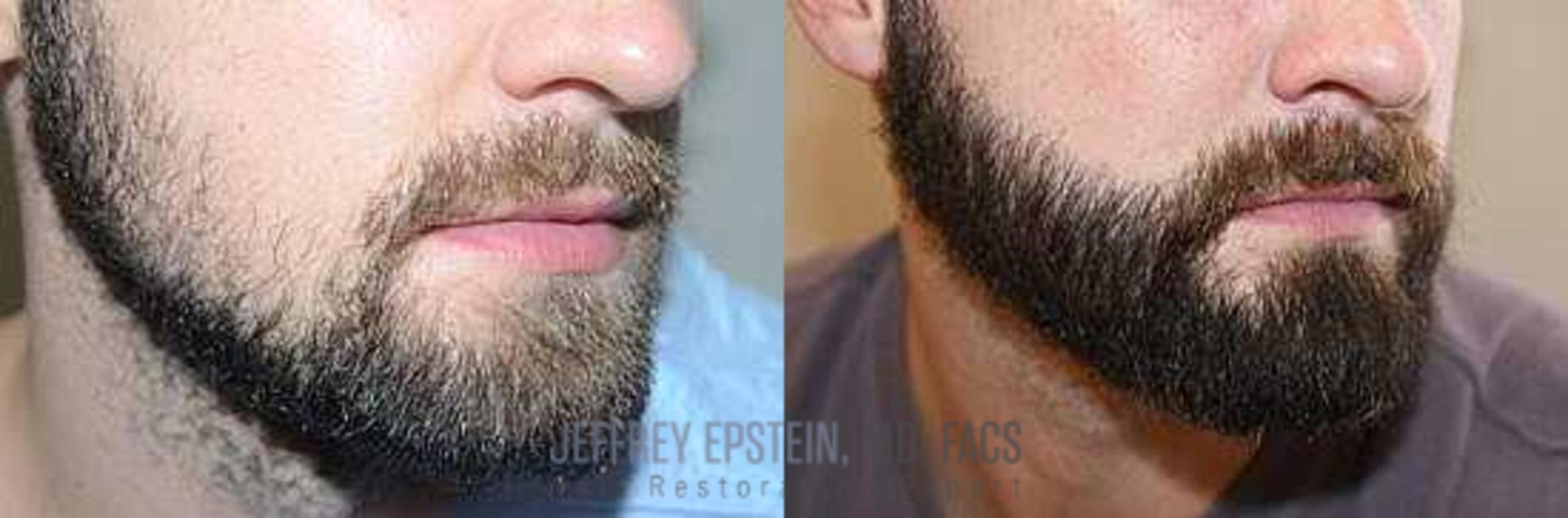 Before & After Beard Transplant Case 383 View 3 View in Miami, FL
