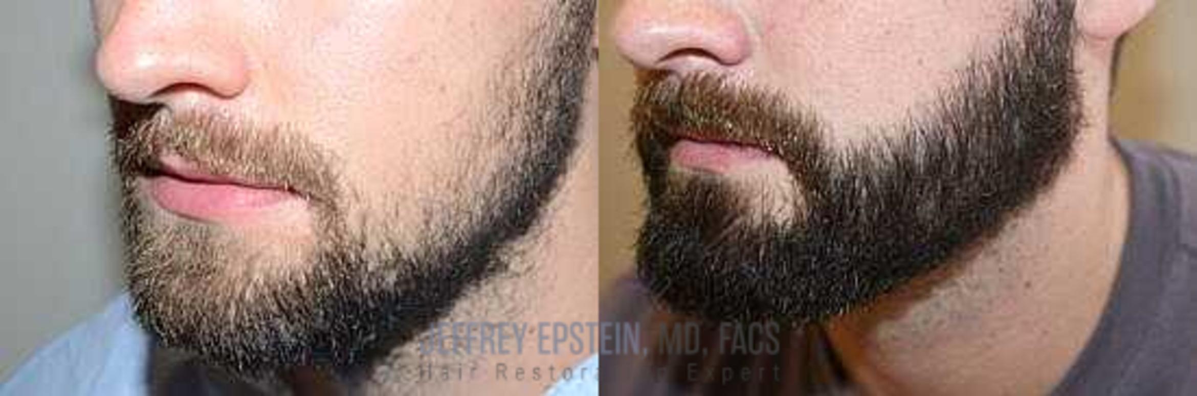 Before & After Beard Transplant Case 383 View 4 View in Miami, FL
