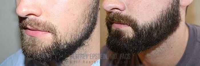 Before & After Beard Transplant Case 383 View 4 View in Miami, FL