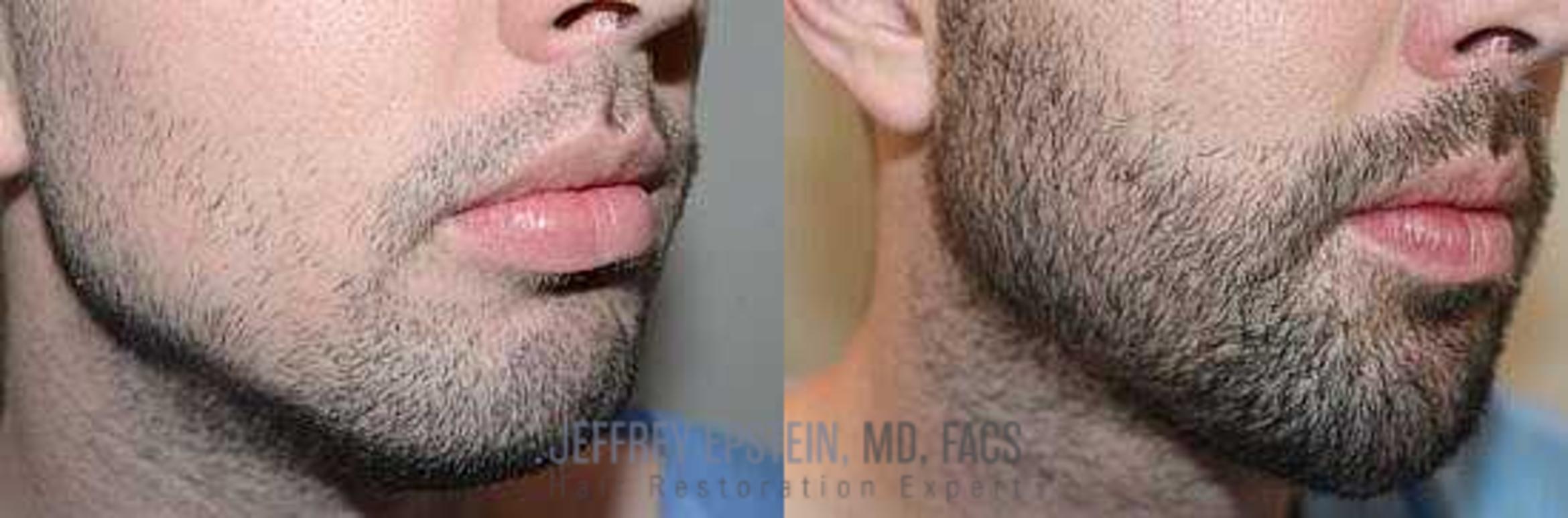 Before & After Beard Transplant Case 384 View 1 View in Miami, FL