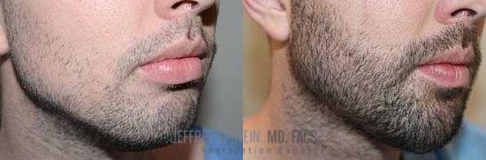 Before & After Beard Transplant Case 384 View 1 View in Miami, FL