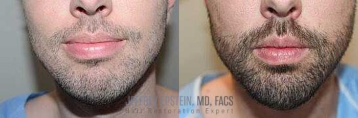 Before & After Beard Transplant Case 384 View 2 View in Miami, FL