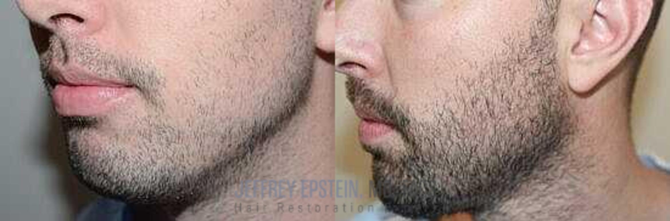 Before & After Beard Transplant Case 384 View 3 View in Miami, FL