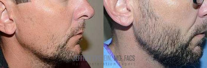 Before & After Beard Transplant Case 385 View 1 View in Miami, FL