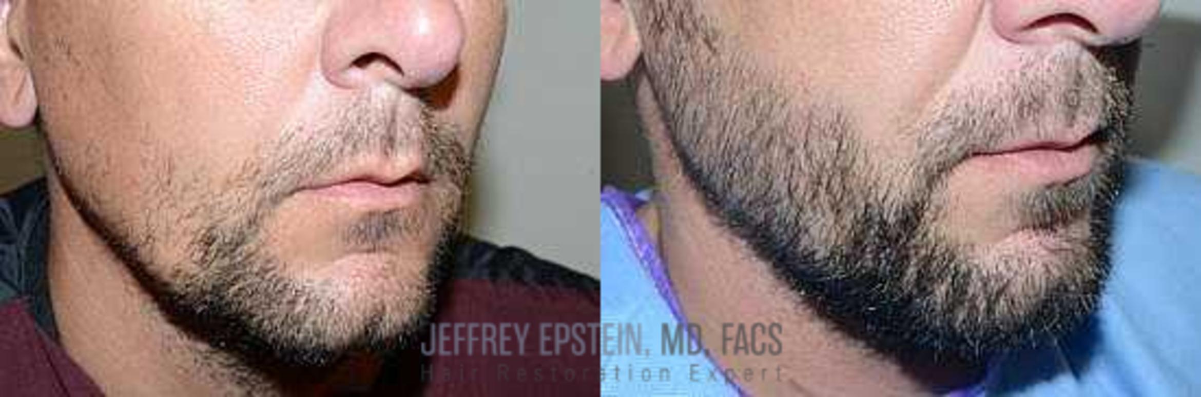 Before & After Beard Transplant Case 385 View 2 View in Miami, FL