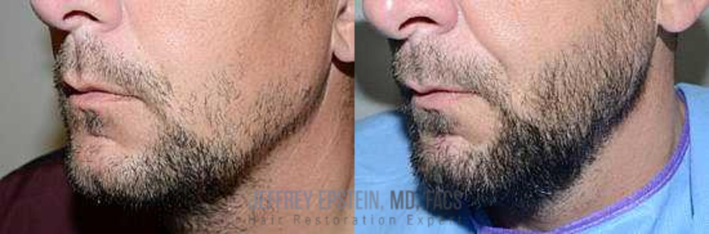 Before & After Beard Transplant Case 385 View 3 View in Miami, FL