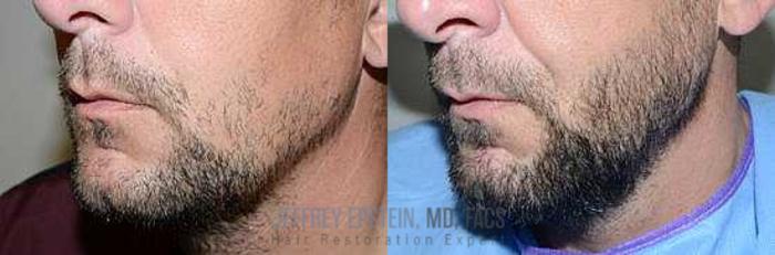 Before & After Beard Transplant Case 385 View 3 View in Miami, FL
