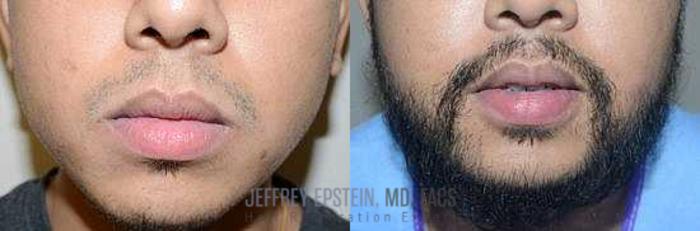 Before & After Beard Transplant Case 386 View 1 View in Miami, FL