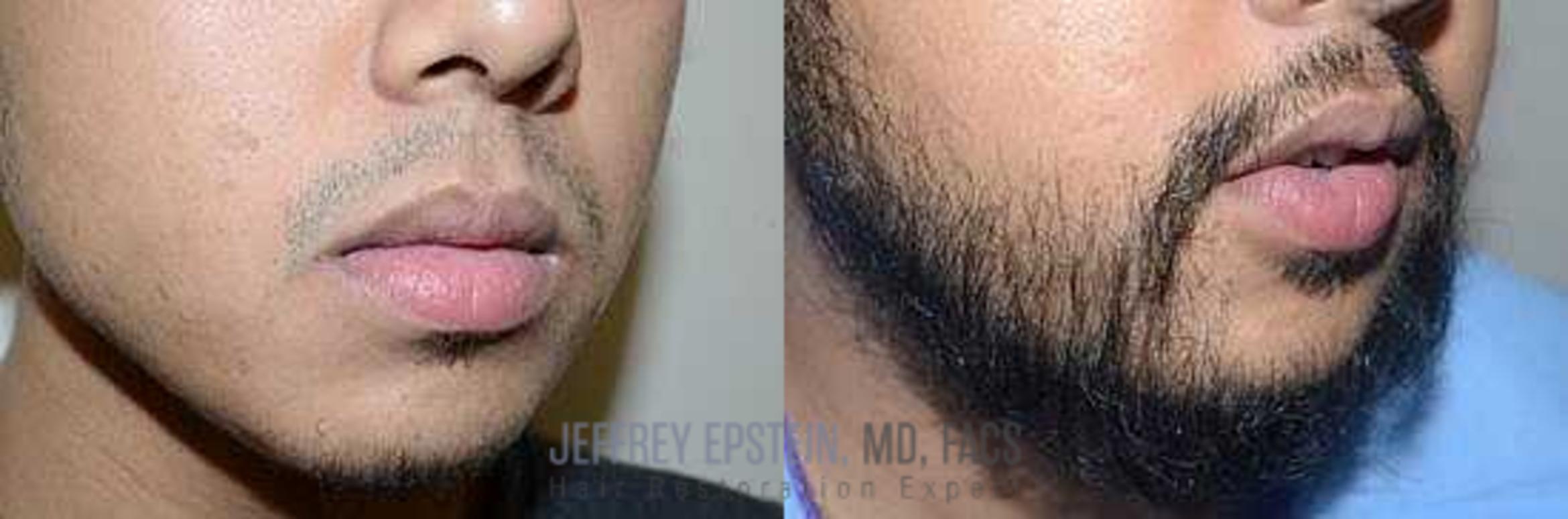 Before & After Beard Transplant Case 386 View 2 View in Miami, FL