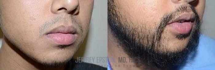 Before & After Beard Transplant Case 386 View 2 View in Miami, FL