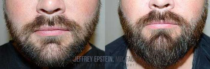 Before & After Beard Transplant Case 387 View 1 View in Miami, FL