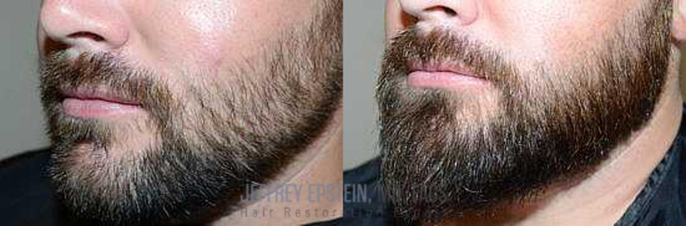 Before & After Beard Transplant Case 387 View 2 View in Miami, FL