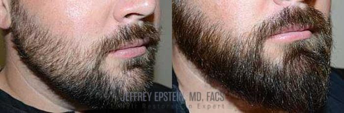 Before & After Beard Transplant Case 387 View 3 View in Miami, FL