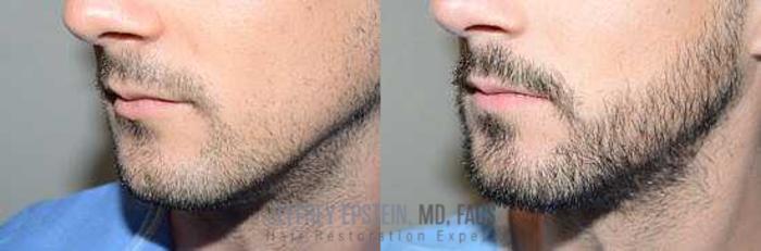 Before & After Beard Transplant Case 388 View 1 View in Miami, FL