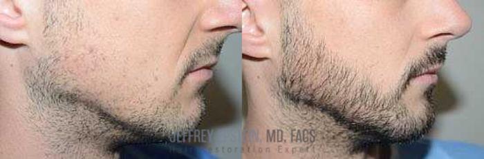 Before & After Beard Transplant Case 388 View 2 View in Miami, FL