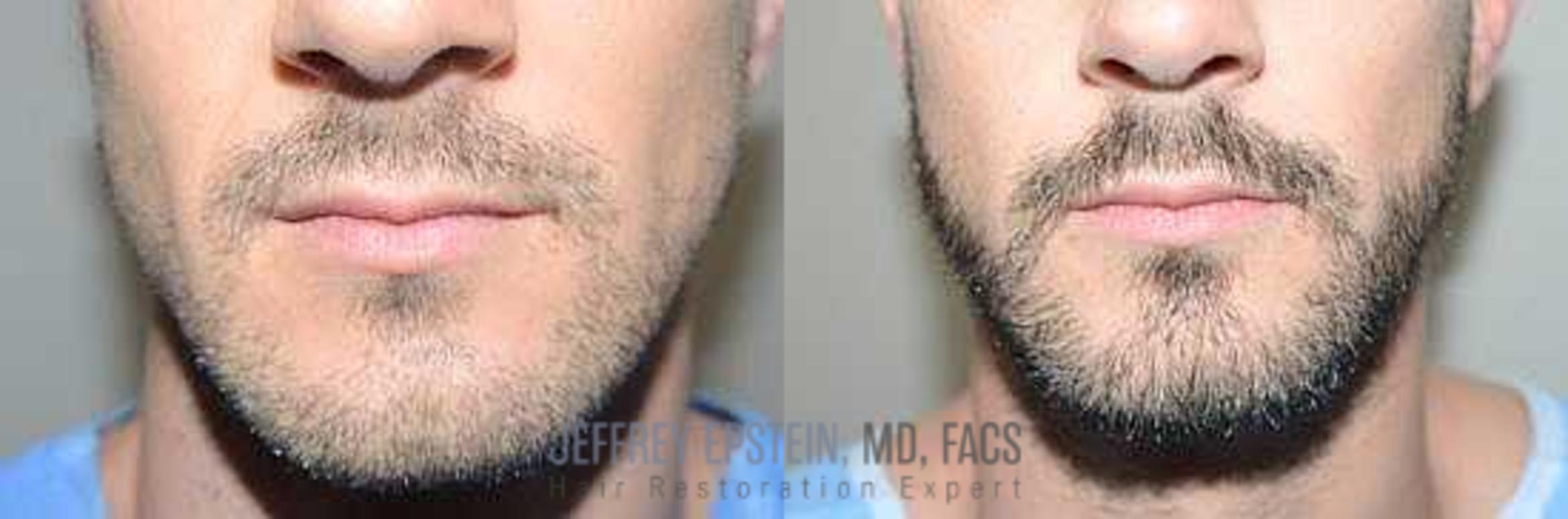 Before & After Beard Transplant Case 388 View 3 View in Miami, FL