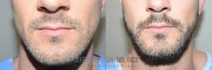 Before & After Beard Transplant Case 388 View 3 View in Miami, FL