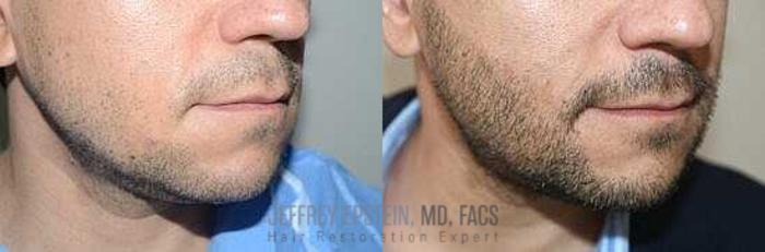 Before & After Beard Transplant Case 389 View 1 View in Miami, FL
