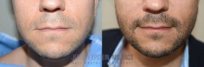 Before & After Beard Transplant Case 389 View 2 View in Miami, FL
