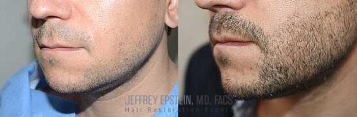 Before & After Beard Transplant Case 389 View 3 View in Miami, FL