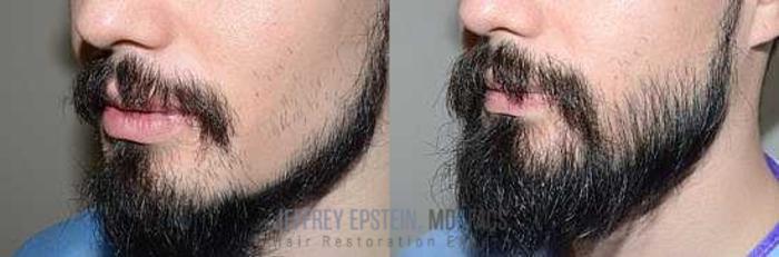 Before & After Beard Transplant Case 390 View 1 View in Miami, FL
