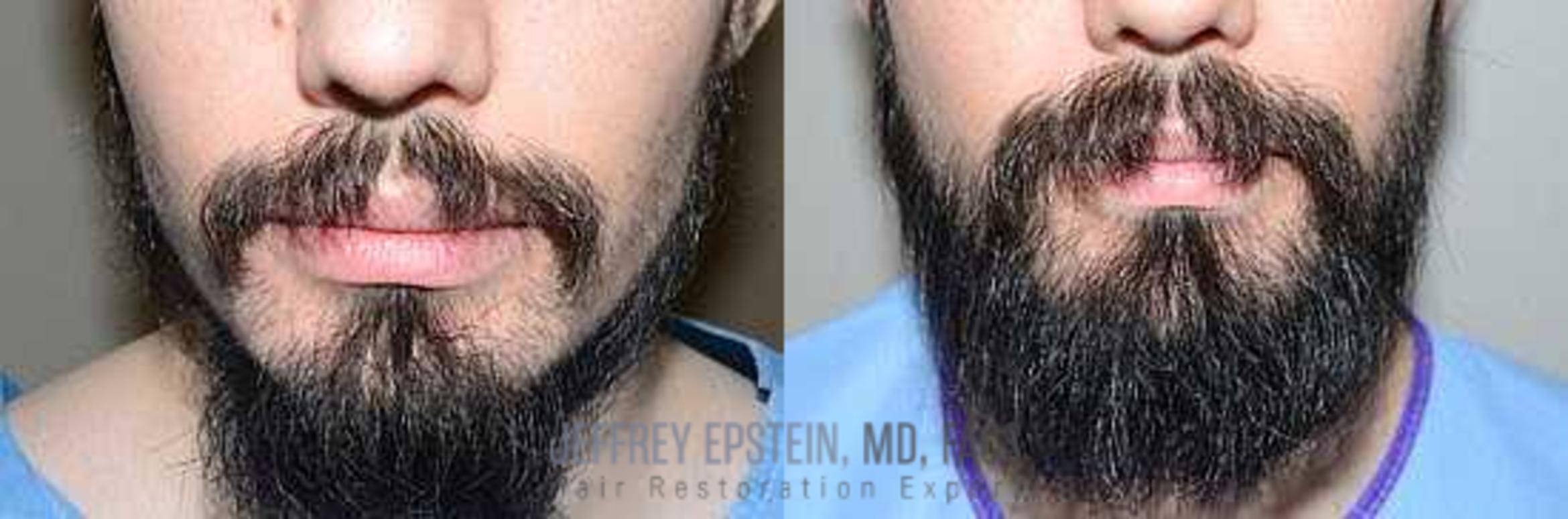 Before & After Beard Transplant Case 390 View 2 View in Miami, FL