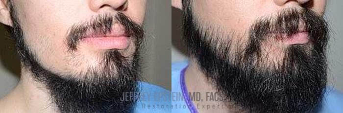 Before & After Beard Transplant Case 390 View 3 View in Miami, FL
