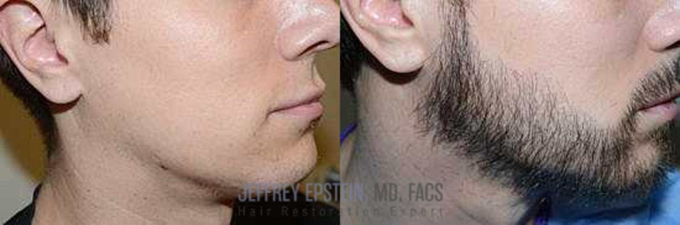 Before & After Beard Transplant Case 391 View 1 View in Miami, FL