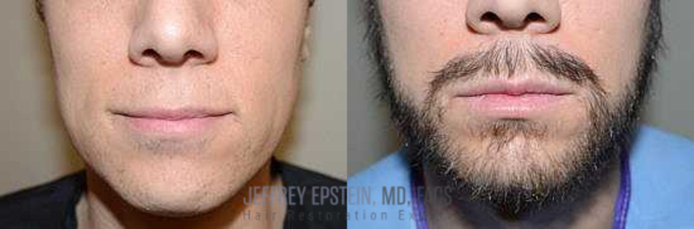 Before & After Beard Transplant Case 391 View 2 View in Miami, FL