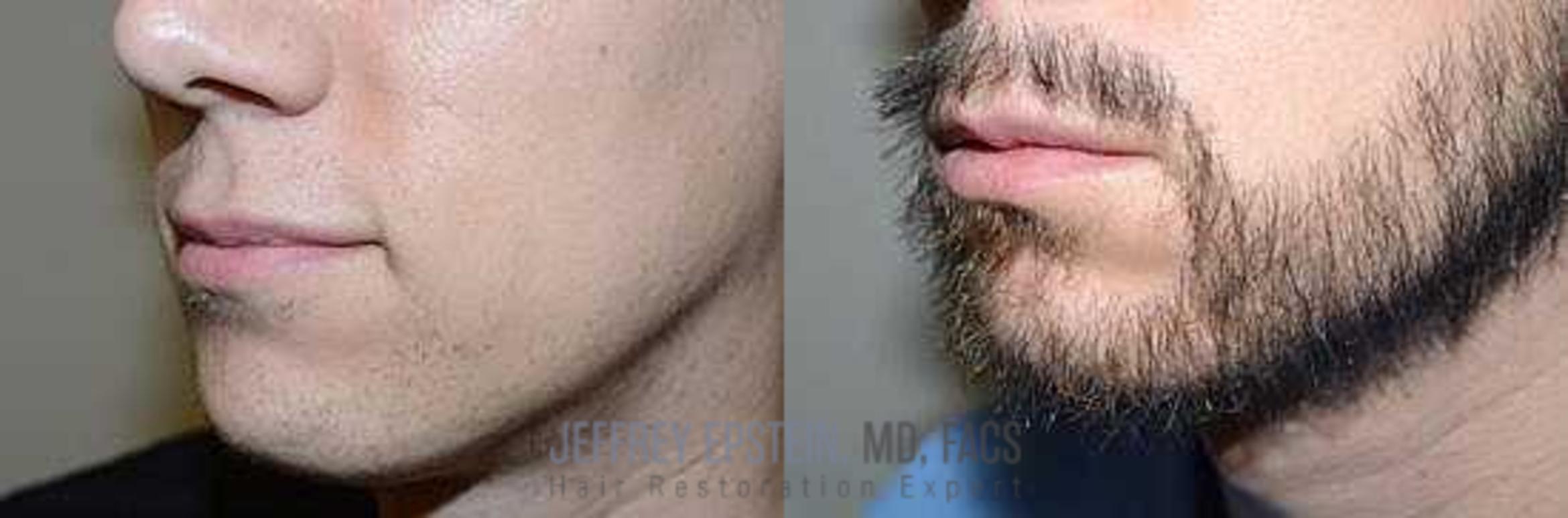 Before & After Beard Transplant Case 391 View 3 View in Miami, FL