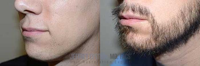 Before & After Beard Transplant Case 391 View 3 View in Miami, FL