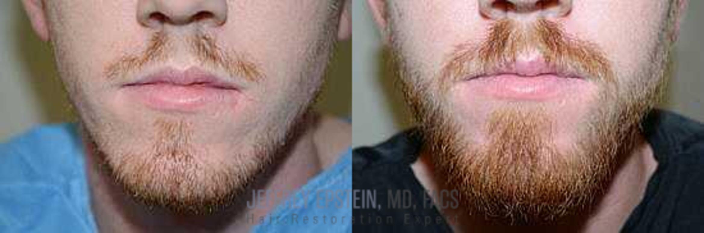 Before & After Beard Transplant Case 392 View 1 View in Miami, FL