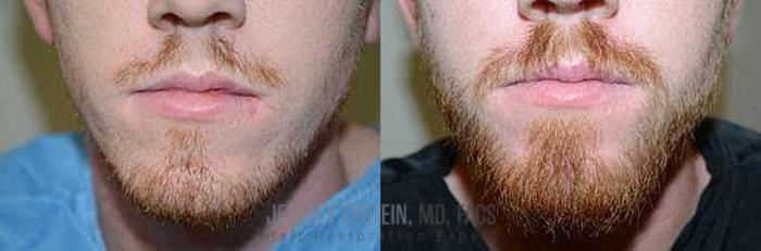 Before & After Beard Transplant Case 392 View 1 View in Miami, FL