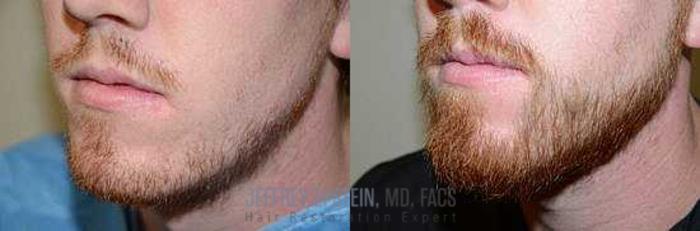 Before & After Beard Transplant Case 392 View 2 View in Miami, FL