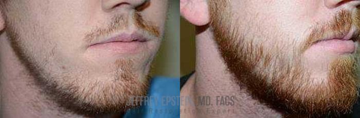 Before & After Beard Transplant Case 392 View 3 View in Miami, FL