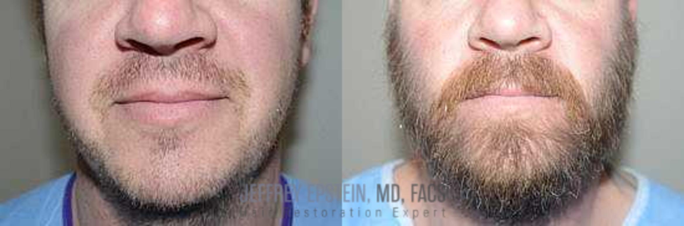 Before & After Beard Transplant Case 393 View 1 View in Miami, FL