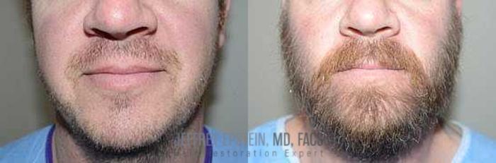 Before & After Beard Transplant Case 393 View 1 View in Miami, FL
