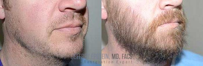 Before & After Beard Transplant Case 393 View 2 View in Miami, FL