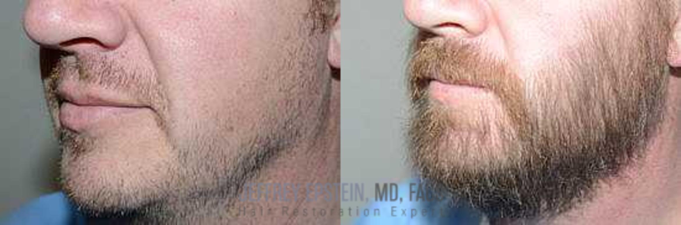 Before & After Beard Transplant Case 393 View 3 View in Miami, FL