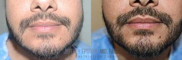 Before & After Beard Transplant Case 394 View 1 View in Miami, FL
