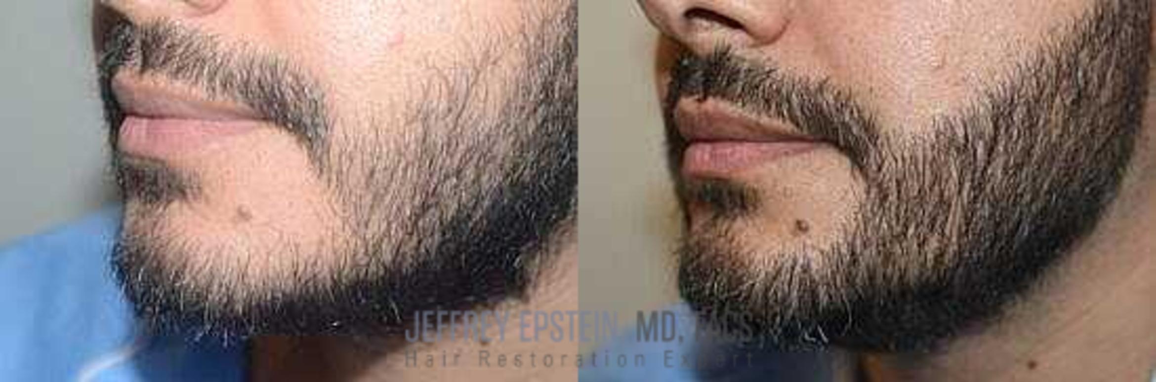 Before & After Beard Transplant Case 394 View 2 View in Miami, FL