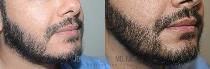 Before & After Beard Transplant Case 394 View 3 View in Miami, FL