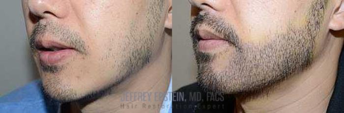 Before & After Beard Transplant Case 395 View 1 View in Miami, FL