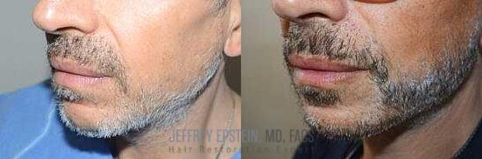 Before & After Beard Transplant Case 396 View 1 View in Miami, FL