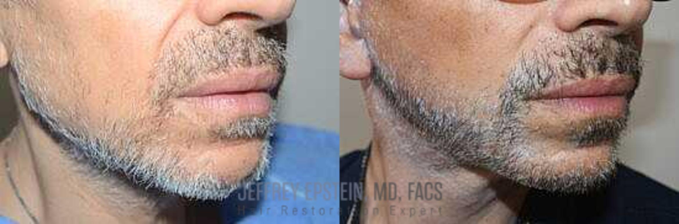 Before & After Beard Transplant Case 396 View 2 View in Miami, FL