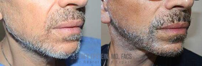 Before & After Beard Transplant Case 396 View 2 View in Miami, FL