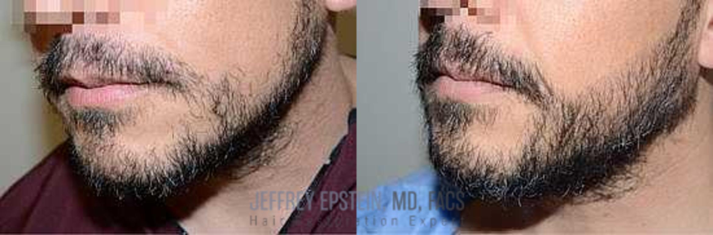 Before & After Beard Transplant Case 397 View 1 View in Miami, FL